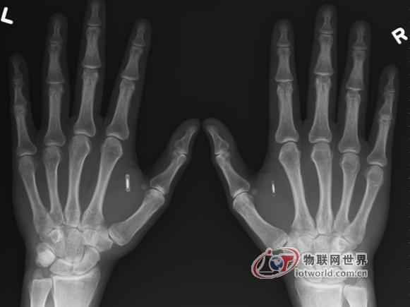 人体植入电子芯片：游戏开发者植NFC芯片入手，物联网世界网